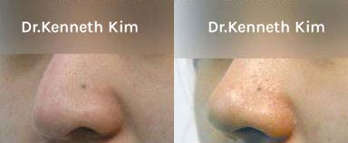 Nose Surgery Patient-5