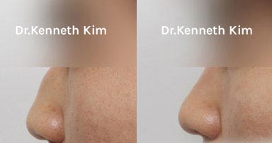 Nose Surgery Patient-6