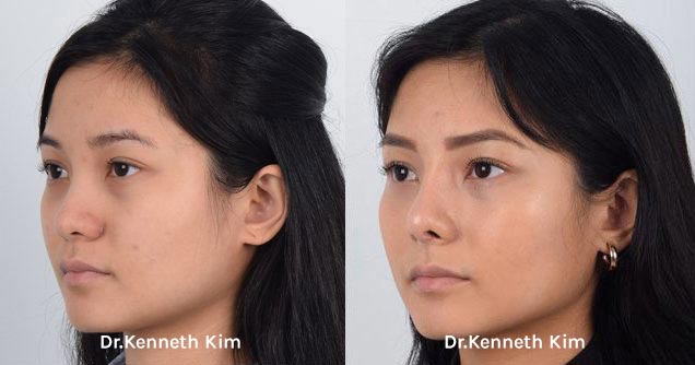 Nose Surgery Patient-11