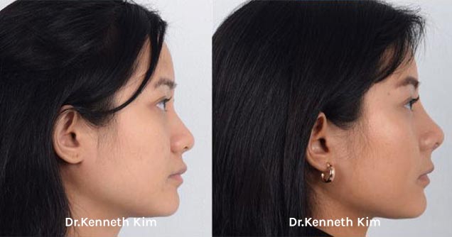 Nose Surgery Patient-11