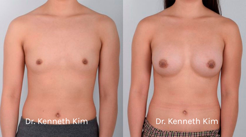Breast Surgery