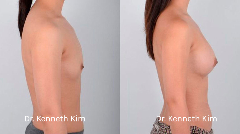 Breast Augmentation Patient-3