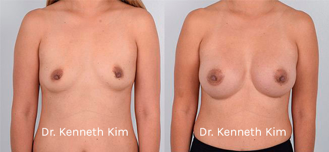 Breast Augmentation Patient-2