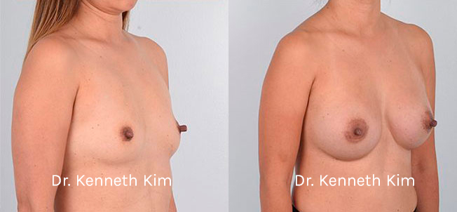 Breast Augmentation Patient-2