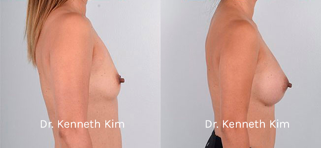 Breast Augmentation Patient-2