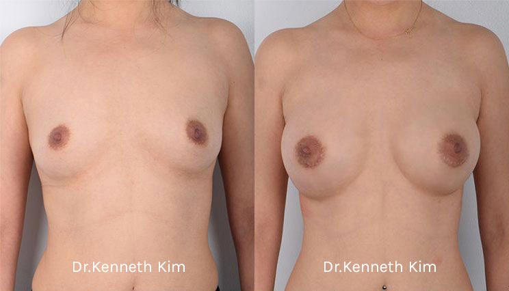 Breast Augmentation Patient-6