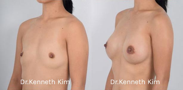 Breast Augmentation Patient-5