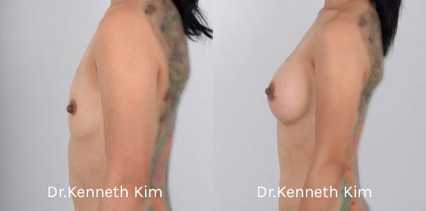 Breast Augmentation Patient-5