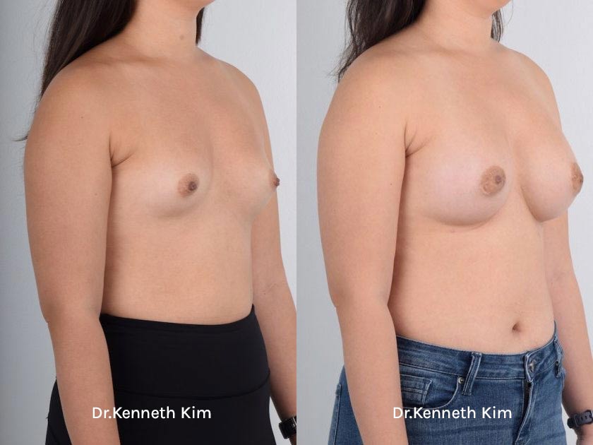 Breast Augmentation Patient-4