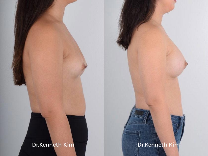 Breast Augmentation Patient-4