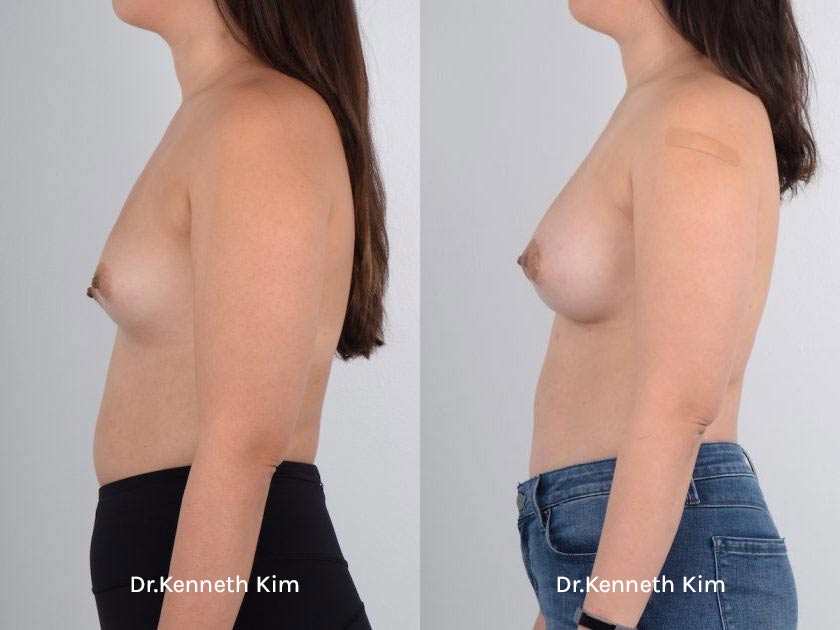 Breast Augmentation Patient-4