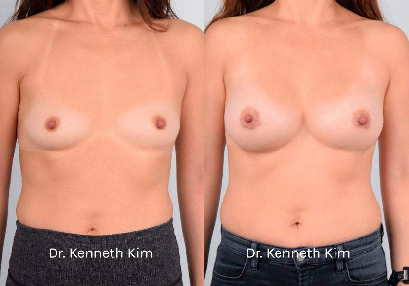 Breast Augmentation Patient-1