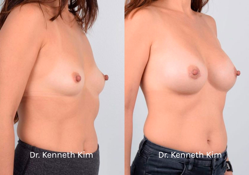 Breast Augmentation Patient-1