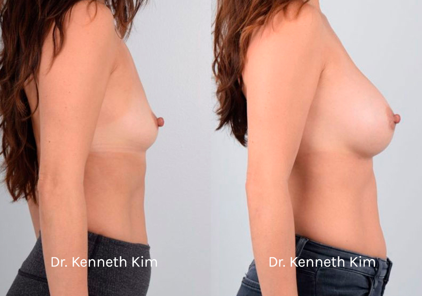 Breast Augmentation Patient-1