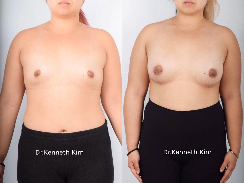 Breast Augmentation Patient-8