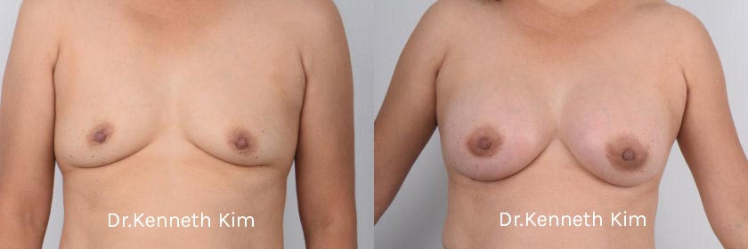 Breast Augmentation Patient-9