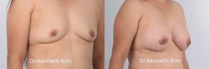 Breast Augmentation Patient-9