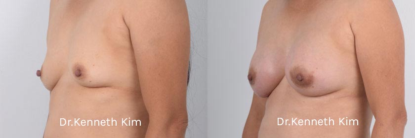 Breast Augmentation Patient-9