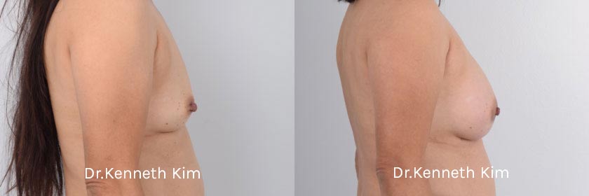 Breast Augmentation Patient-9