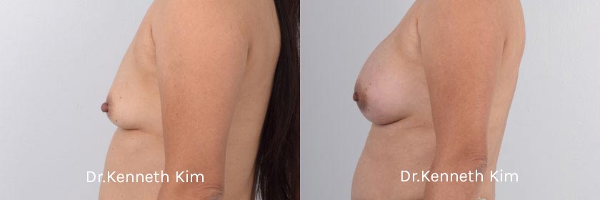 Breast Augmentation Patient-9