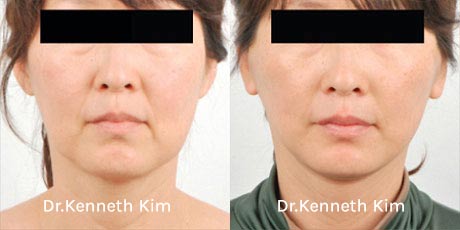 Facelift Patient-3