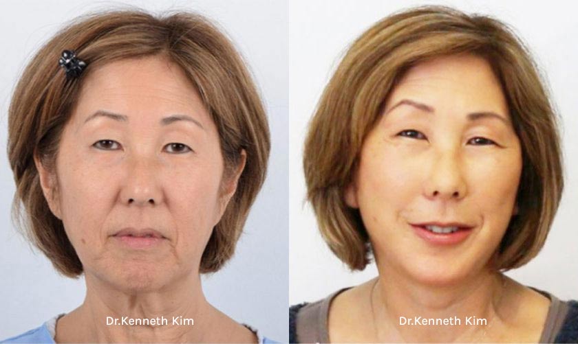Facelift Patient-4