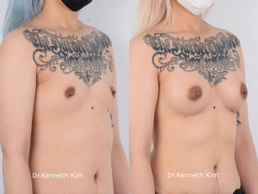 Breast Augmentation Patient-7