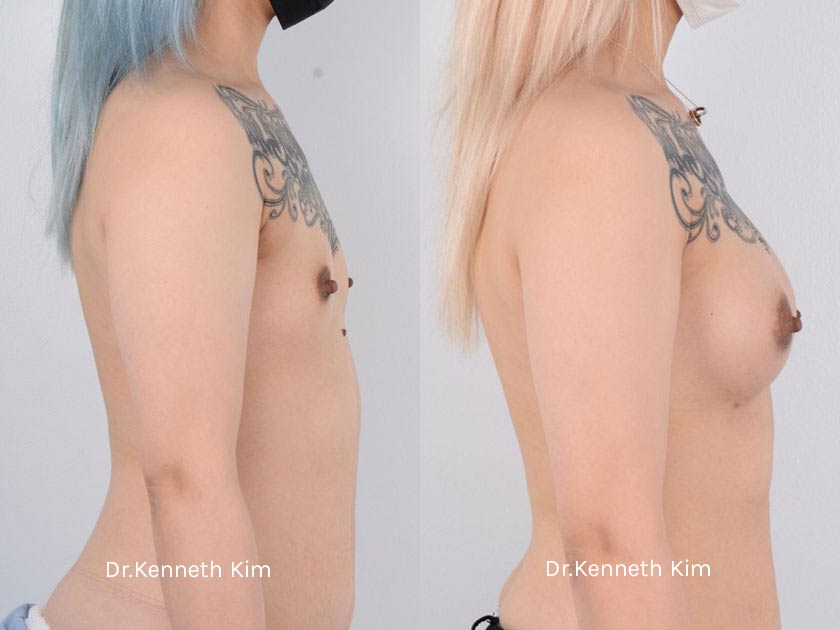 Breast Augmentation Patient-7