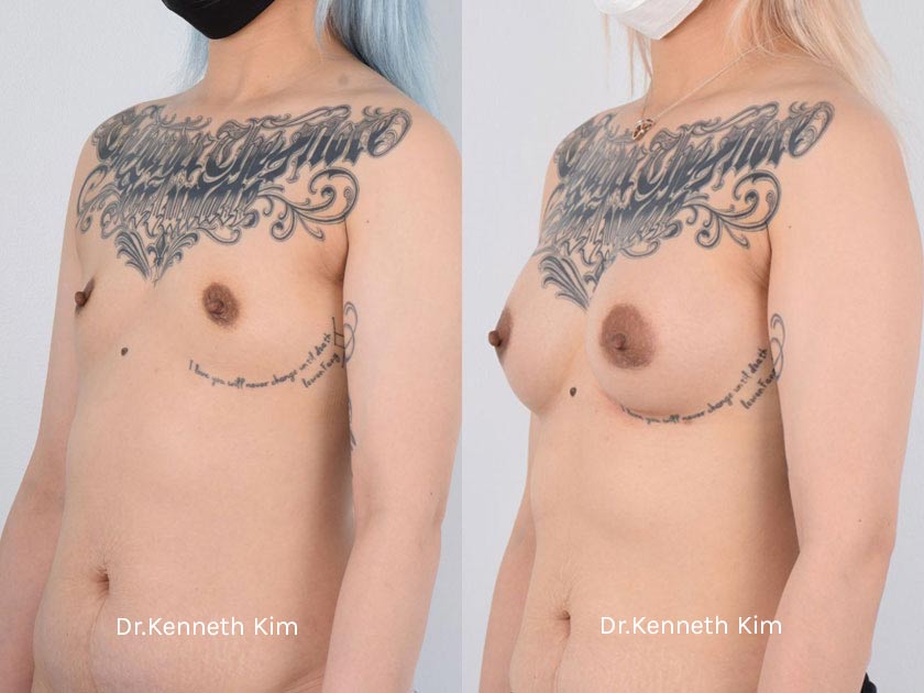 Breast Augmentation Patient-7