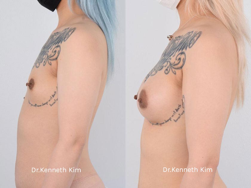 Breast Augmentation Patient-7