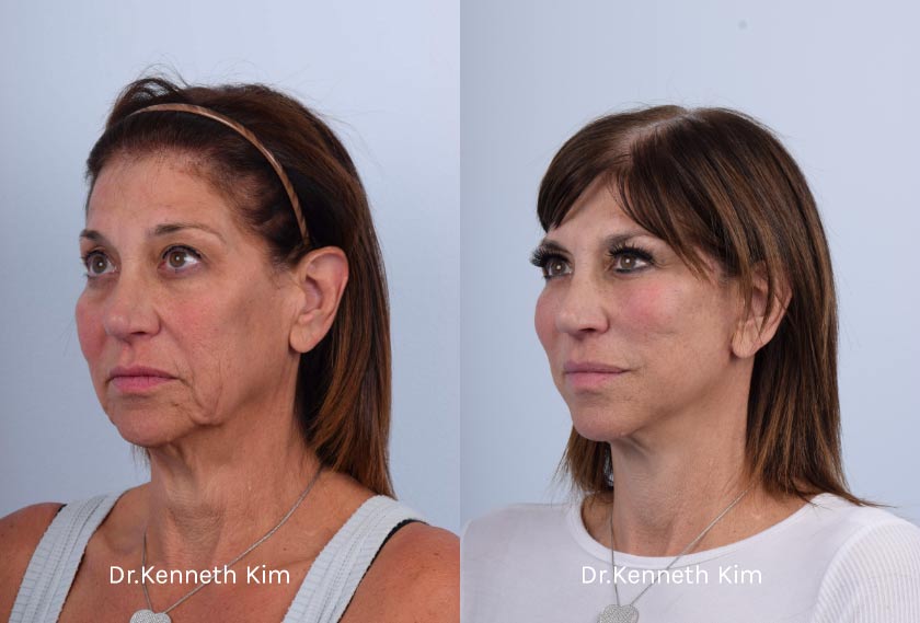 Facelift Patient-15 side