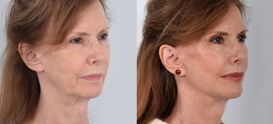 Facelift and Neck Lift