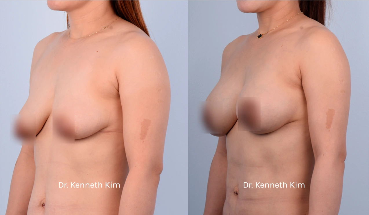 Breast Augmentation Patient 15 - 2