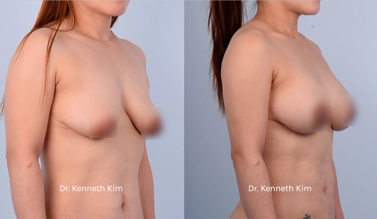 Breast Augmentation Patient 15 - 4