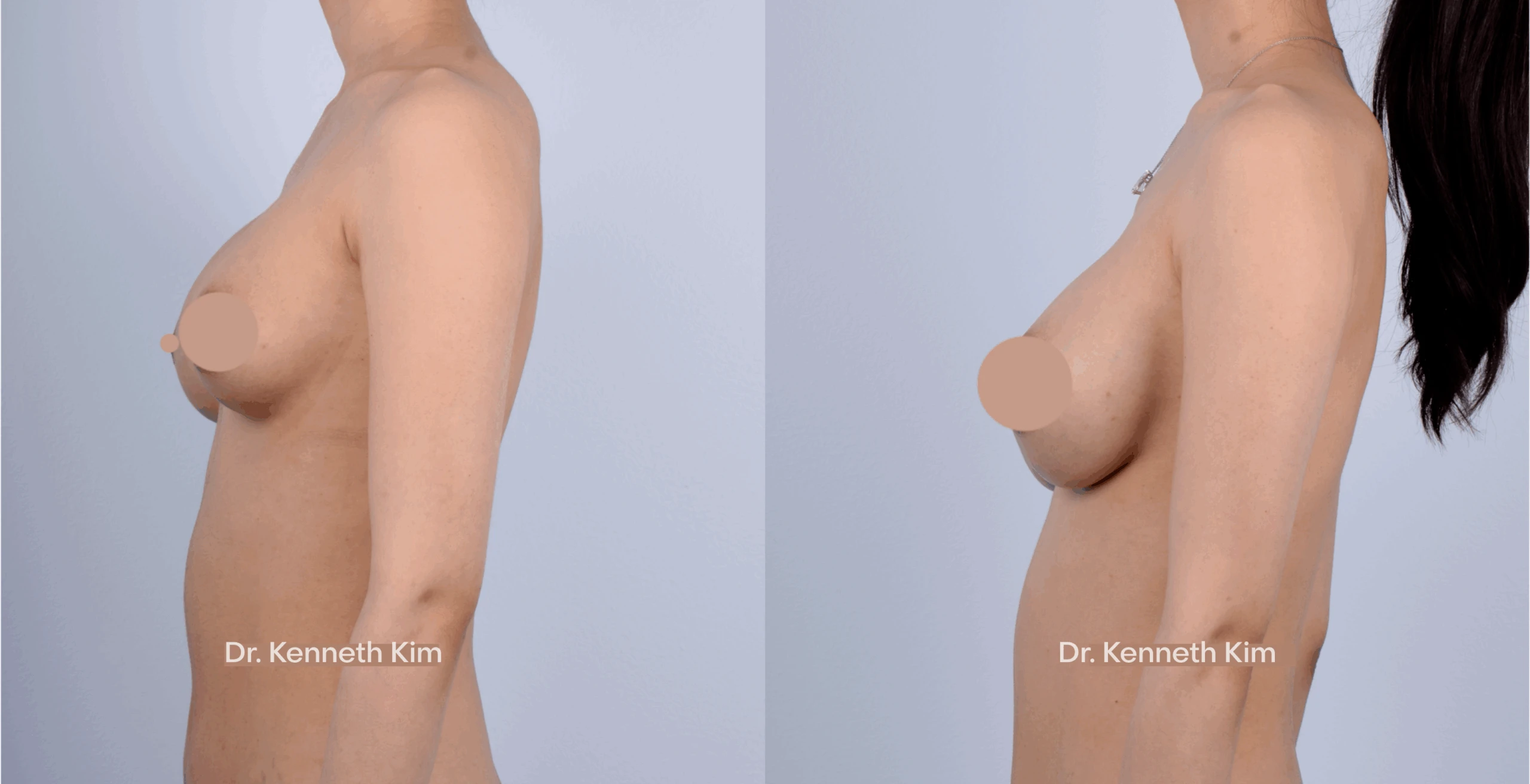 Breast Augmentation Patient 16