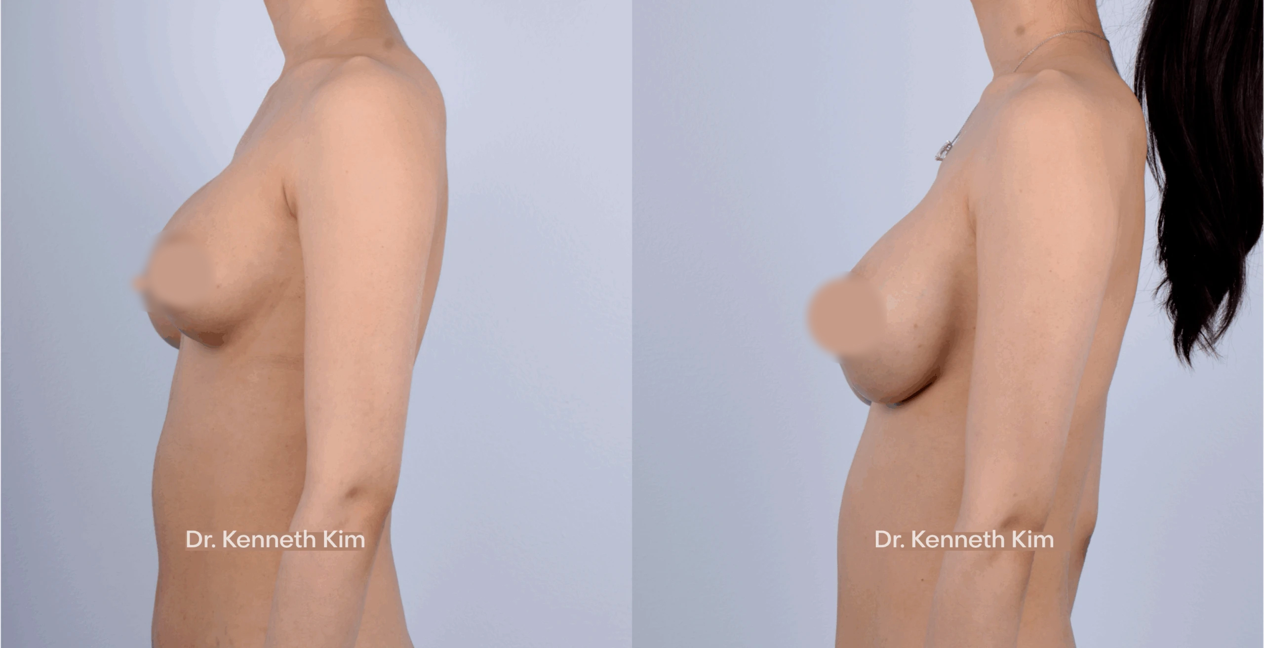 Breast-Augmentation-Patient-16-3A