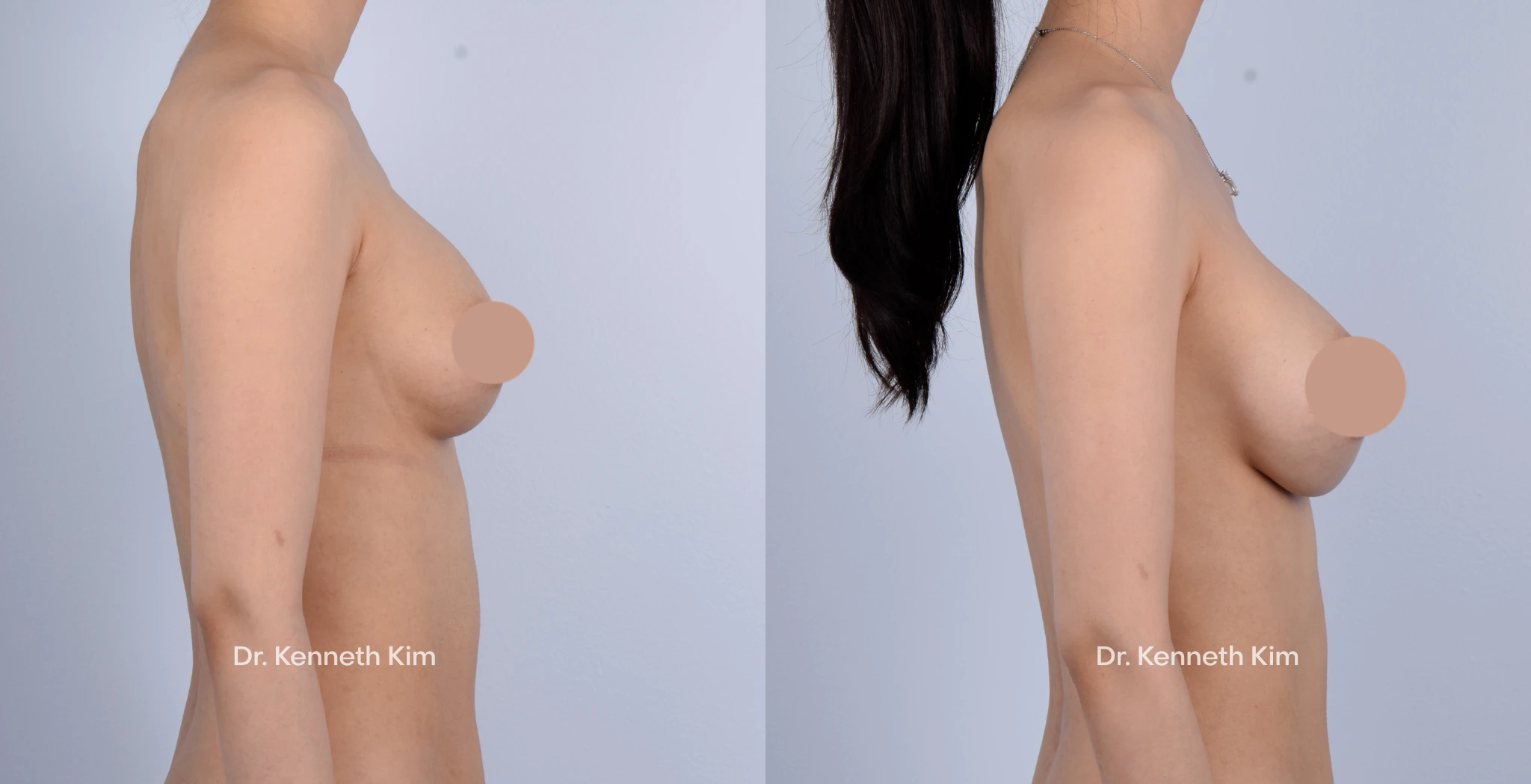 Breast Augmentation Patient 16