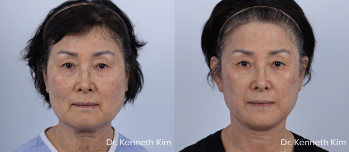 Facelift Patient