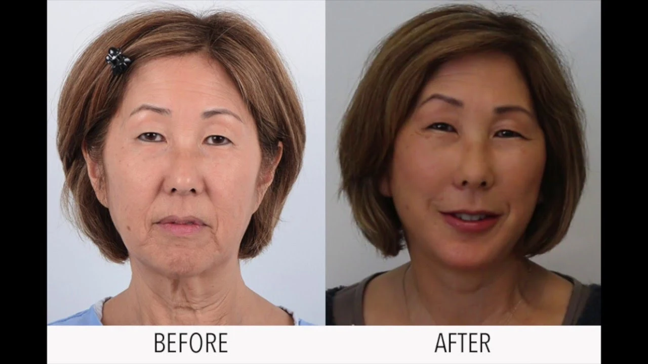 Lori, CA – Face Lift