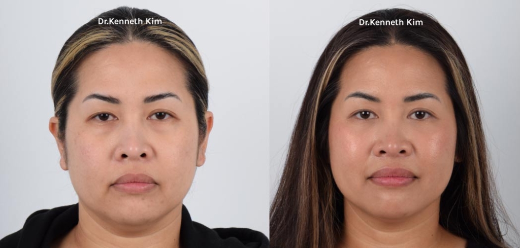 Lower Eyelid Blepharoplasty
