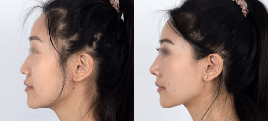 Rhinoplasty