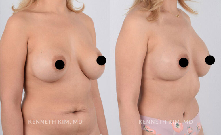 mommy-makeover-patient1c-768x471