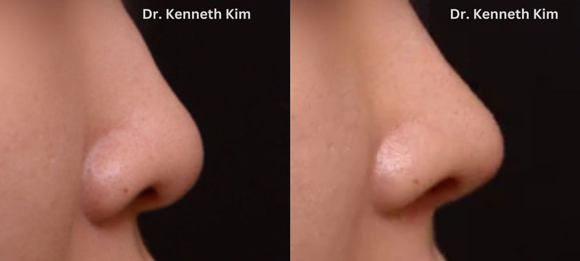 Before and after photos of nasal cartilage reshaping for a smoother bridge and defined nose tip after professional nose plastic surgery.