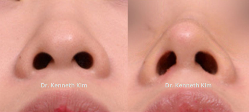 Before and after photos of nasal cartilage reshaping for a smoother bridge and defined nose tip after professional nose plastic surgery.