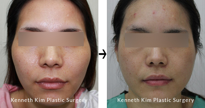 Facial Bone Surgery in Los Angeles | V-Line Surgery