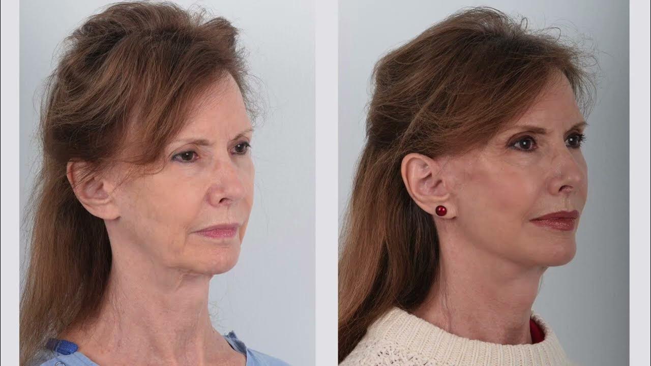 Awake Bloodless Facelift Surgery | Click to watch on YouTube