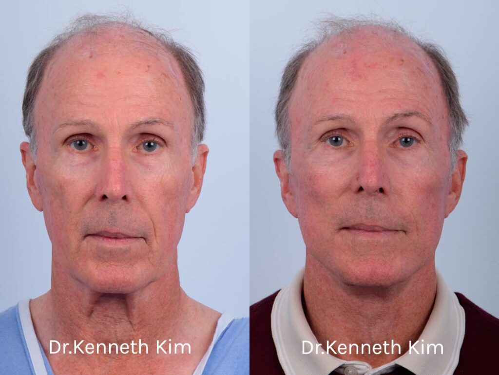 Male patient in his 70s underwent an awake facelift and neck lift, which improved signs of aging in the midface, lower face, and neck. Dr. Kim uses local anesthesia (no general anesthesia or intravenous/twilight sedation) for these procedures, which is the safest way to have surgery and produces the most optimal results. A lesser-discussed yet significant anesthetic risk associated with general anesthesia and IV sedation is cognitive dysfunction (memory loss), to which older individuals are more susceptible. By opting for an awake anesthesia facelift and neck lift, our patient avoided this anesthetic risk. A key differentiator of Dr. Kim's face and neck lifts is that he performs a bloodless dissection. His no-bleeding technique leads to a faster recovery, the most effective facial elevation, and the most natural-looking, long-lasting results. He dissects further than traditional facelifts and neck lifts, so that the face is fully redraped and lifted without any tension, thus avoiding a pulled, unnatural appearance. This patient's facelift corrected sagging in the jowls, created a smooth and defined jawline, and elevated the cheeks. The neck lift significantly improved skin laxity (loose skin) and tightened the underlying neck muscles. Patients often combine these procedures for a more comprehensive facial rejuvenation.
   

