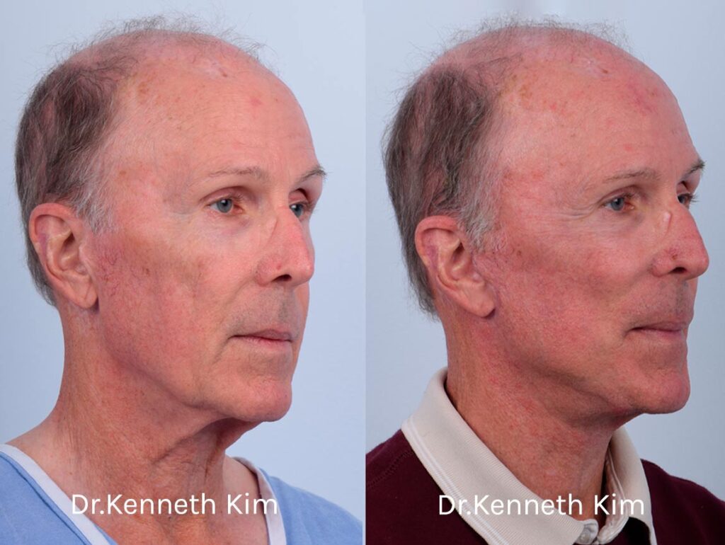 Male patient in his 70s underwent an awake facelift and neck lift, which improved signs of aging in the midface, lower face, and neck. Dr. Kim uses local anesthesia (no general anesthesia or intravenous/twilight sedation) for these procedures, which is the safest way to have surgery and produces the most optimal results. A lesser-discussed yet significant anesthetic risk associated with general anesthesia and IV sedation is cognitive dysfunction (memory loss), to which older individuals are more susceptible. By opting for an awake anesthesia facelift and neck lift, our patient avoided this anesthetic risk. A key differentiator of Dr. Kim's face and neck lifts is that he performs a bloodless dissection. His no-bleeding technique leads to a faster recovery, the most effective facial elevation, and the most natural-looking, long-lasting results. He dissects further than traditional facelifts and neck lifts, so that the face is fully redraped and lifted without any tension, thus avoiding a pulled, unnatural appearance. This patient's facelift corrected sagging in the jowls, created a smooth and defined jawline, and elevated the cheeks. The neck lift significantly improved skin laxity (loose skin) and tightened the underlying neck muscles. Patients often combine these procedures for a more comprehensive facial rejuvenation.
   

