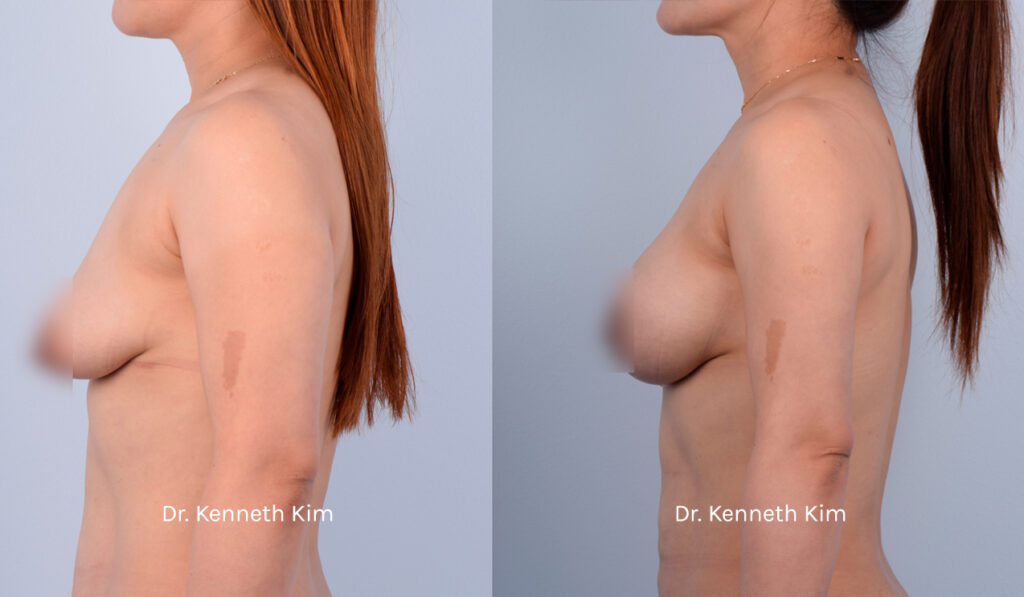 Patient underwent an awake breast lift and augmentation to achieve a fuller and more youthful breast shape. The breast lift (mastopexy) elevated the sagging breast tissue and repositioned the nipples to a higher position. The breast augmentation added volume and fullness to her breast shape. Dr. Kim performs these surgeries using local anesthesia, thereby avoiding the risks associated with general anesthesia and intravenous (IV) sedation, such as blood clots and memory loss. Dr. Kim also performs a 'bloodless' surgery where he meticulously avoids blood vessels, as bleeding causes inflammation and capsular contracture (hardened and distorted breast). Dr. Kim's 'bloodless' technique results in the fastest recovery with minimal to no downtime, no need for prescription opioid medications, and the most natural-looking results. This patient was fully awake during her surgery, experienced no pain or discomfort, and was able to walk out of the operating room unassisted. Most of Dr. Kim's patients resume their normal routines right after surgery. The post-op photos show how the awake procedures restored breast shape and added volume, especially to the upper pole (top part of the breast), creating a rounded and lifted appearance.
   

