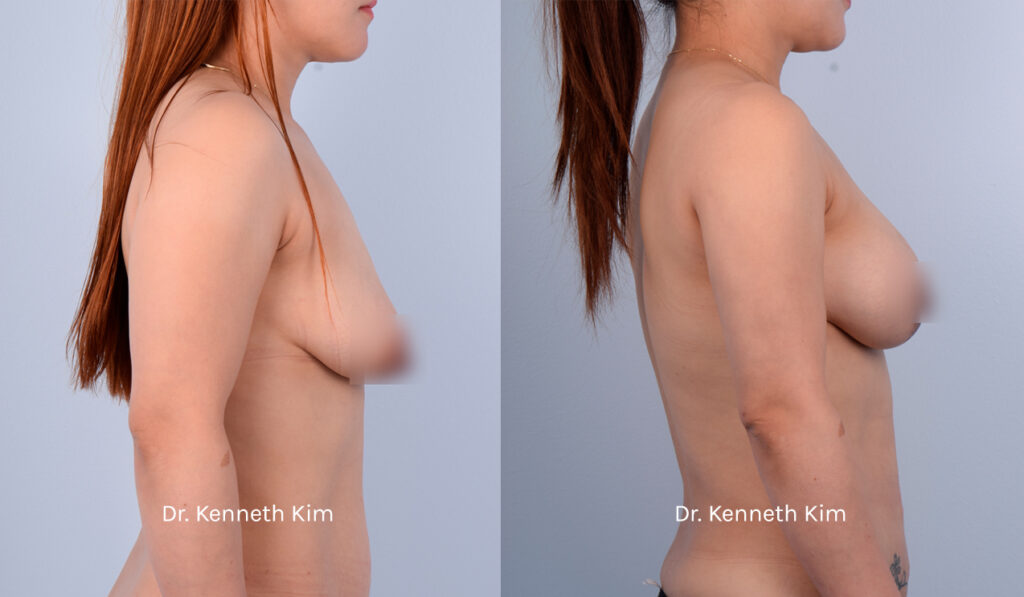 Patient underwent an awake breast lift and augmentation to achieve a fuller and more youthful breast shape. The breast lift (mastopexy) elevated the sagging breast tissue and repositioned the nipples to a higher position. The breast augmentation added volume and fullness to her breast shape. Dr. Kim performs these surgeries using local anesthesia, thereby avoiding the risks associated with general anesthesia and intravenous (IV) sedation, such as blood clots and memory loss. Dr. Kim also performs a 'bloodless' surgery where he meticulously avoids blood vessels, as bleeding causes inflammation and capsular contracture (hardened and distorted breast). Dr. Kim's 'bloodless' technique results in the fastest recovery with minimal to no downtime, no need for prescription opioid medications, and the most natural-looking results. This patient was fully awake during her surgery, experienced no pain or discomfort, and was able to walk out of the operating room unassisted. Most of Dr. Kim's patients resume their normal routines right after surgery. The post-op photos show how the awake procedures restored breast shape and added volume, especially to the upper pole (top part of the breast), creating a rounded and lifted appearance.
   

